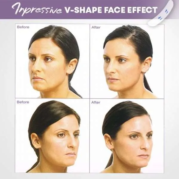 Invisible Face-Lift Kit (40 pieces) - Image 4