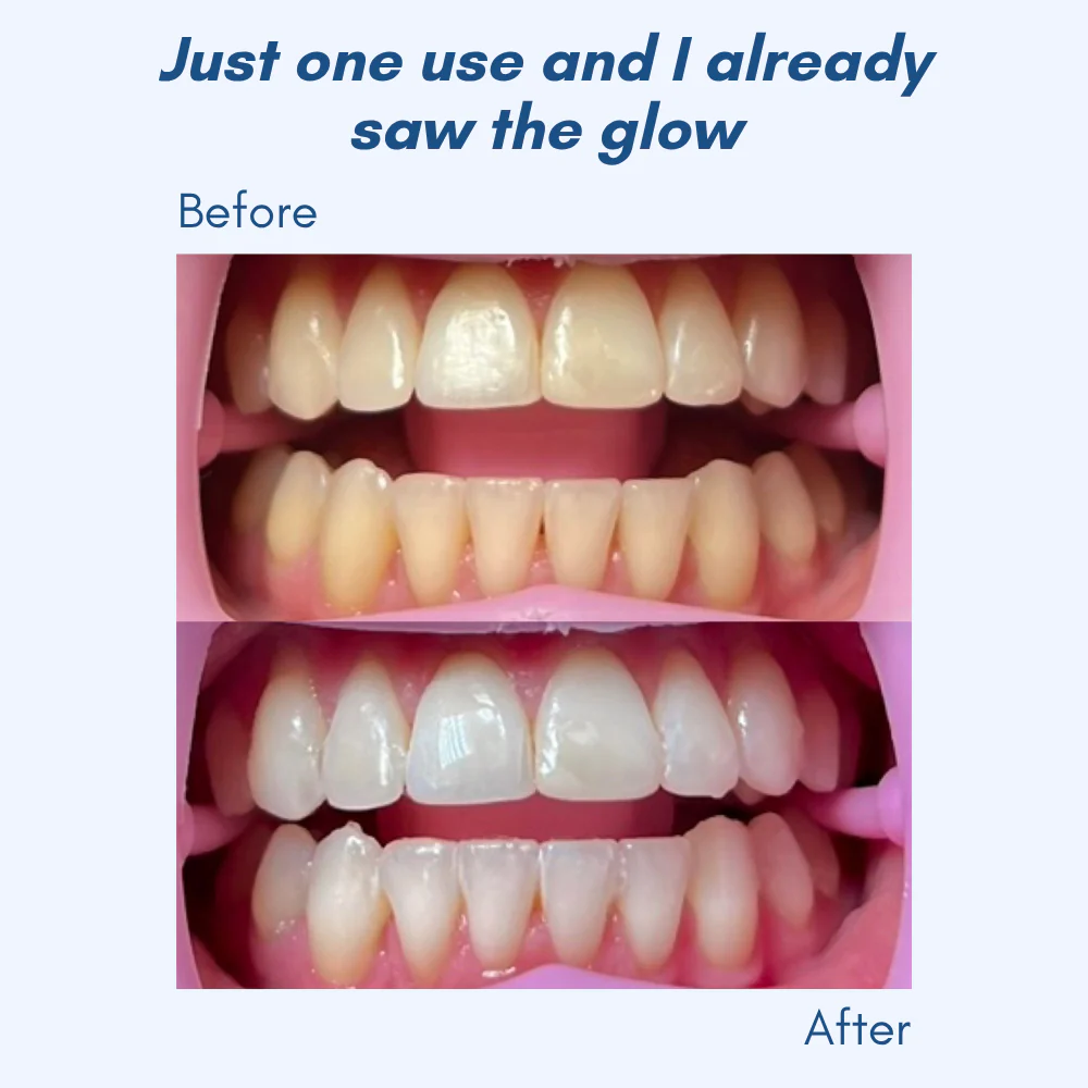 LumaShine™ — Glow Brighter Instantly with a Comfortable, Confidence-Boosting Smile - Image 3