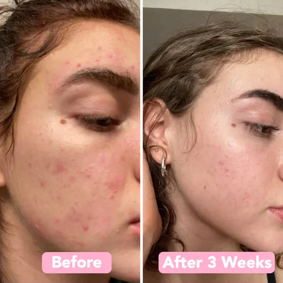 LumiPure™ Pads — Reveal Your Radiant, Even Skin in Just Weeks - Image 9