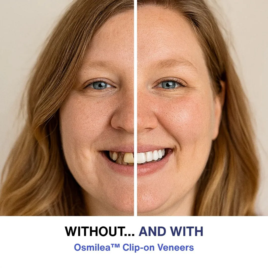 RadianceSnap™ Clip-On Veneers — Effortless Glamour That Boosts Your Confidence Instantly - Image 3