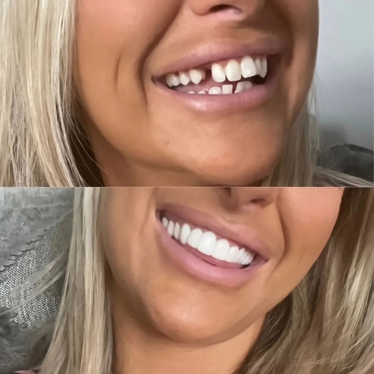 RadianceSnap™ Clip-On Veneers — Effortless Glamour That Boosts Your Confidence Instantly - Image 5