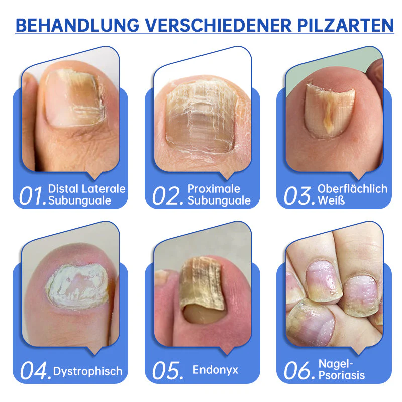 PureNail | Nail Fungus Laser Therapy Device - Your Secret Weapon Against Nail Fungus - Image 11