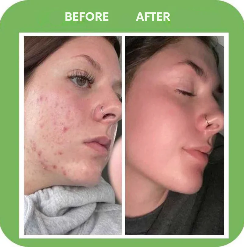 GlowStream™ — Clear Away Breakouts for Radiant, Silky-Soft Skin That Turns Heads - Image 4