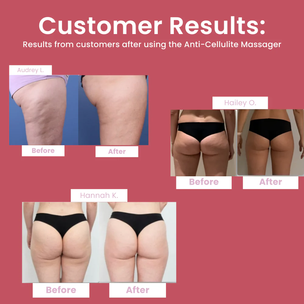 Arivarlo™ - Anti-Cellulite Massager - Image 3